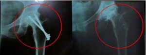 stem cells treatment of joints