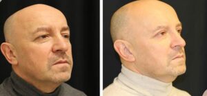 rejuvenation after 30